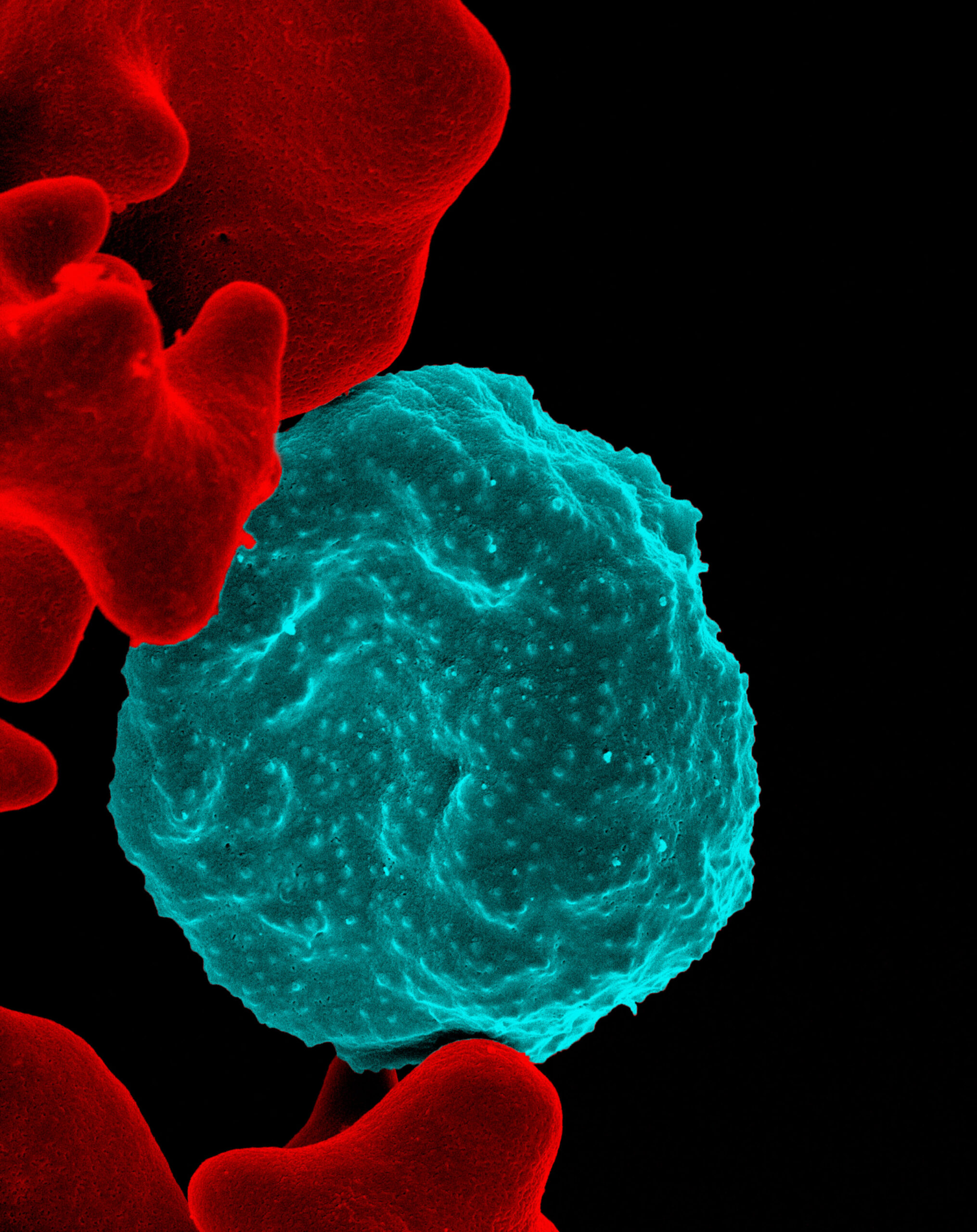 Malaria-infected red blood cell(link is external). Photo credit: NIAID, Flickr 2013, CC-BY2.0.